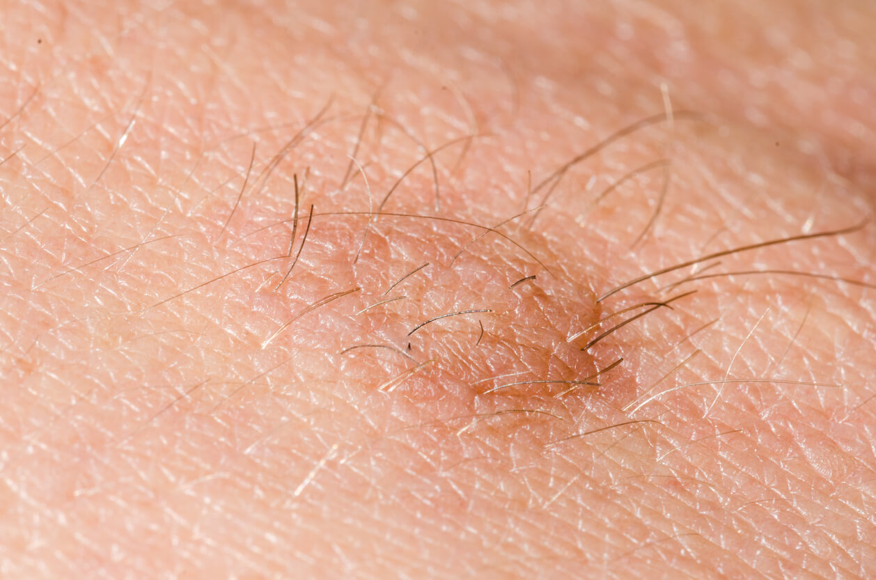 Lunares con pelos en niños: ¿se deben quitar?