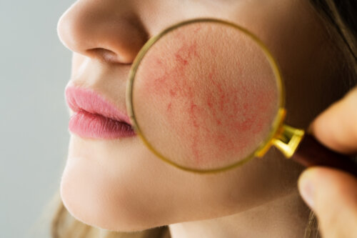 dermatologo lupa pomulo mujer rosacea