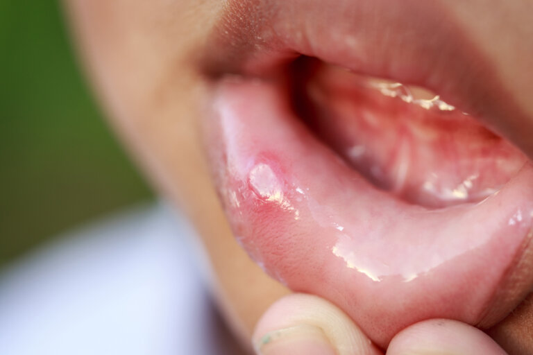 ¿Por qué a los niños les salen llagas en la boca?