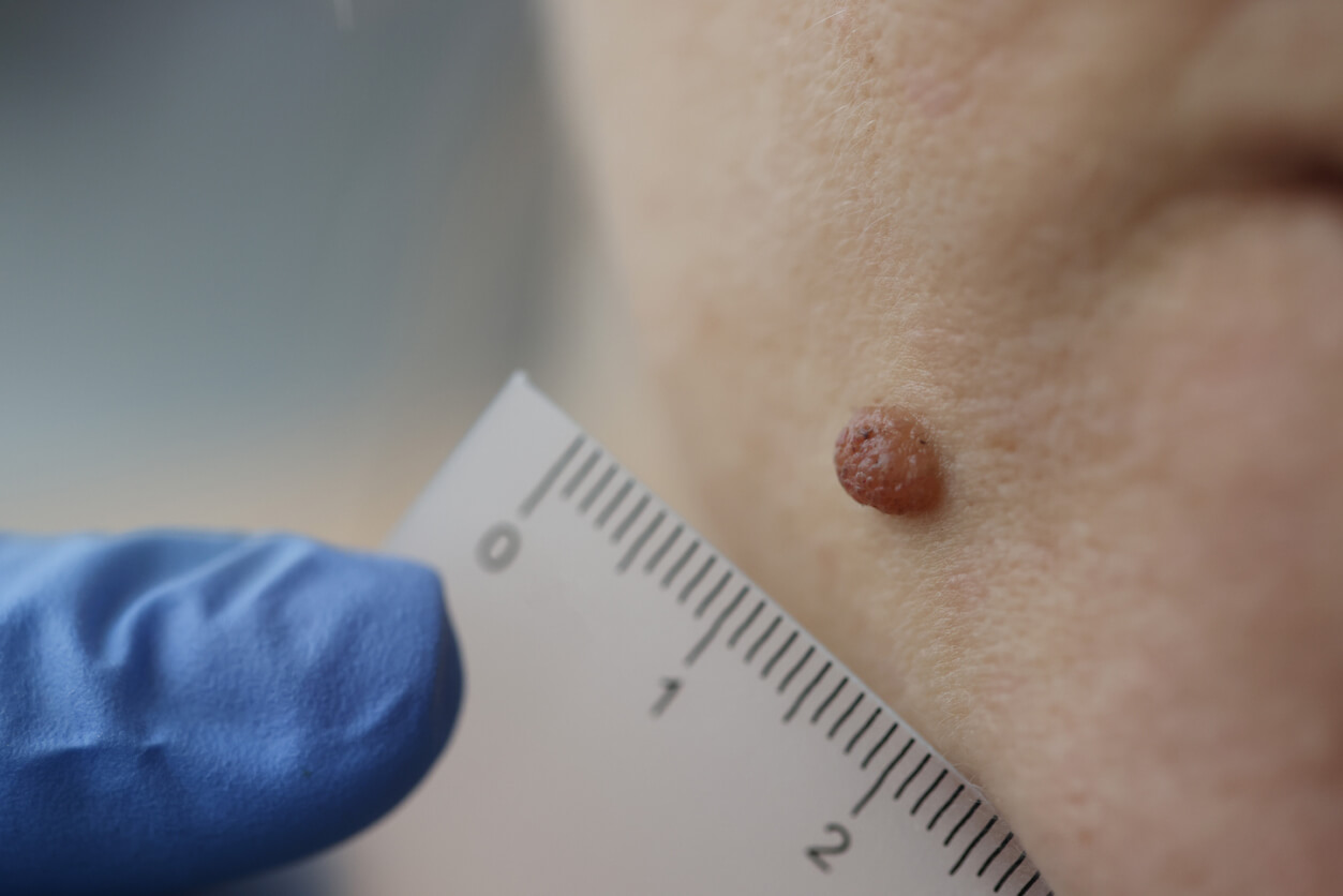 dermatologue mesures naevus naevus patient