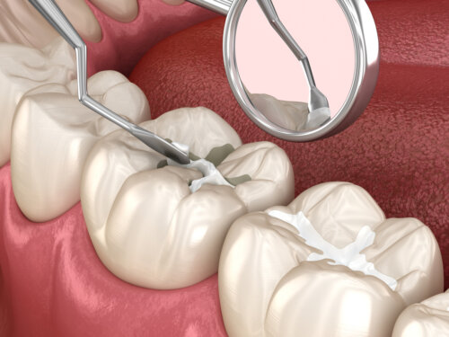 colocacion de pasta en fisura de los dientes