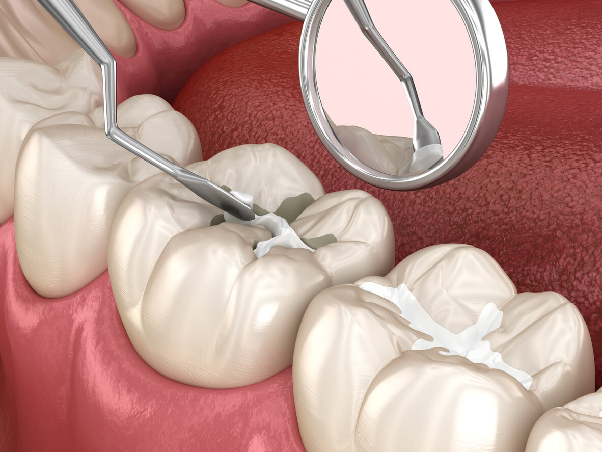 Los 5 beneficios de los selladores dentales para niños