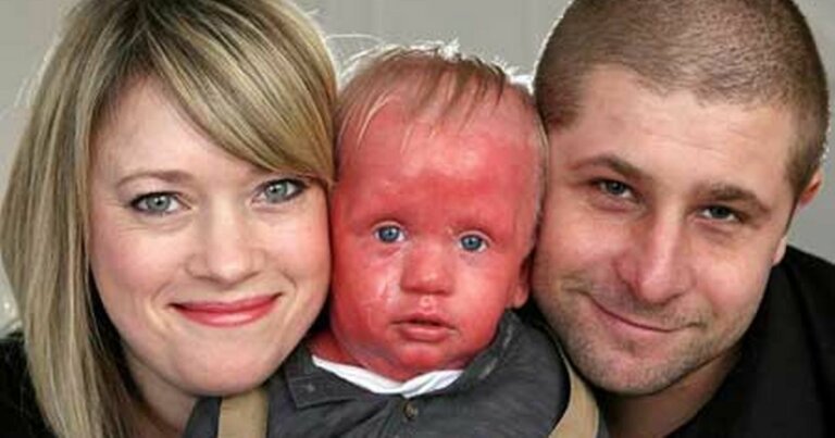 La enfermedad de Netherton: niños con piel roja