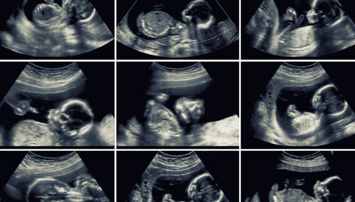 scan fetal ecografia morfologica 20 semanas gestacion