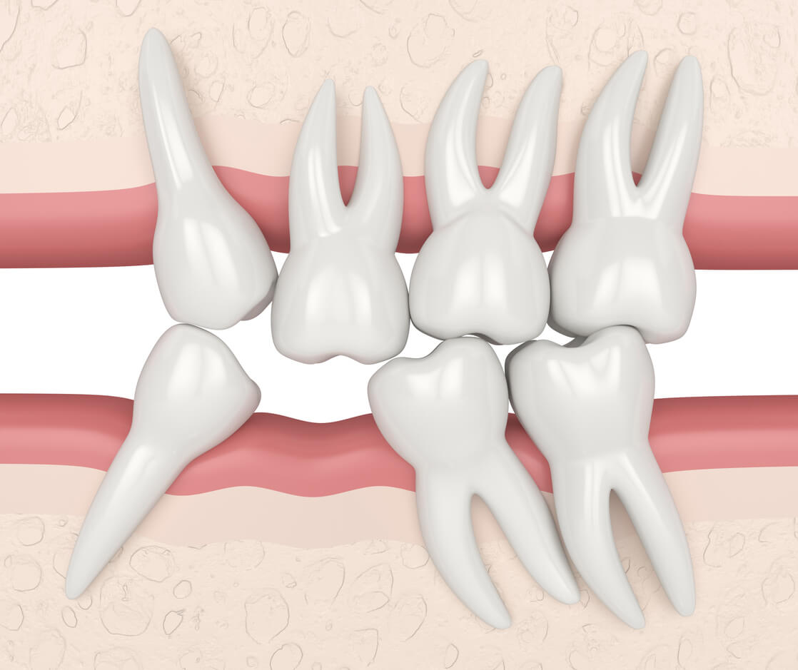 molare spinge verso il basso la crescita eccessiva a causa dell'agenesia dentale