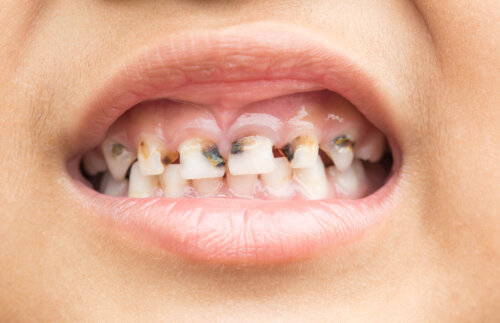 caries y surcos en dientes de leche boca del nino