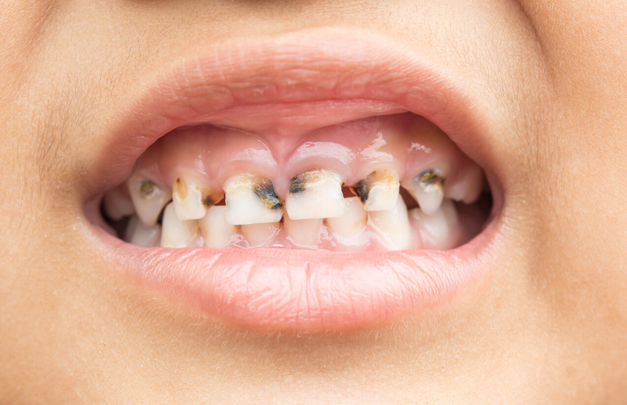 Caries sur les dents de lait d'un enfant.