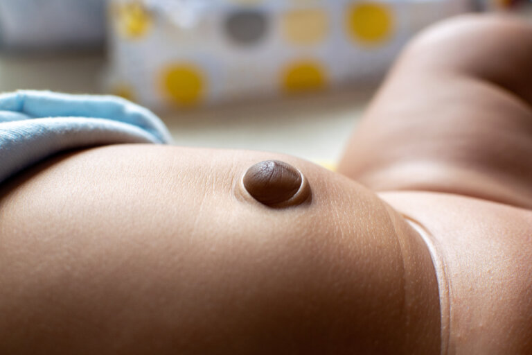 Anomalías en el ombligo del recién nacido