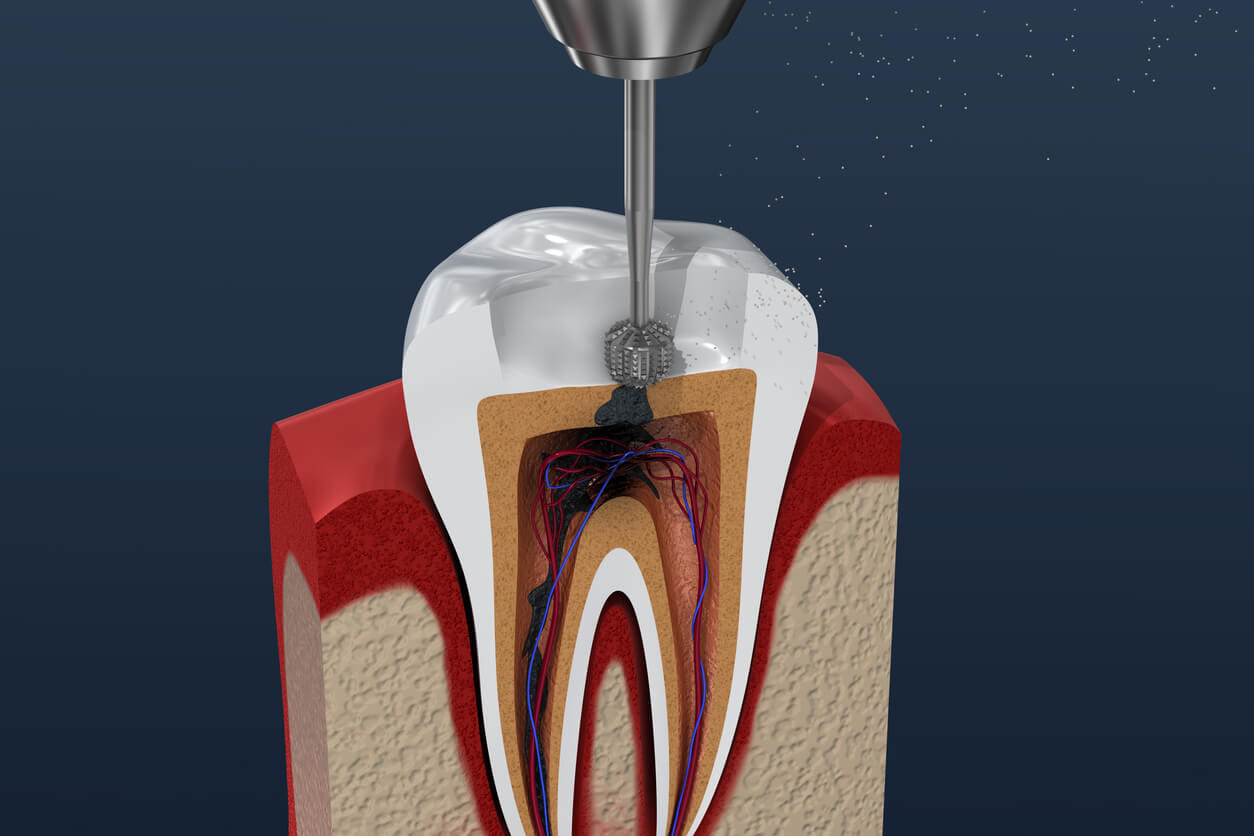 tour de canal radiculaire pour la carie dentaire