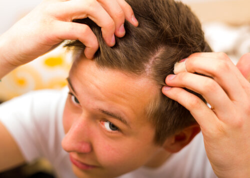 Cómo prevenir la alopecia juvenil
