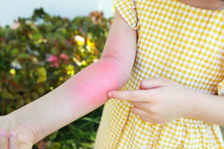 10 consejos para tratar la dermatitis de contacto