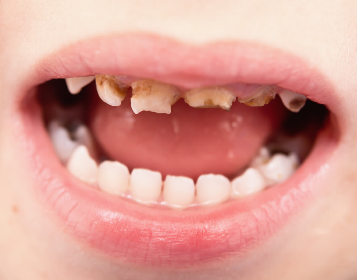 Dentition ébréchée d'un enfant.