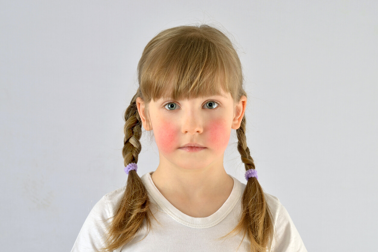 cinquième maladie éruption malaire visage de fille joues rouges signe de gifle