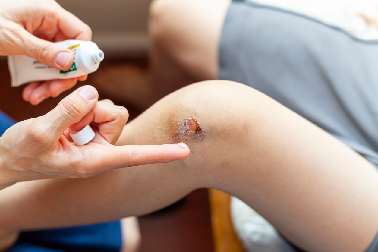 Como tratar heridas infectadas en niños