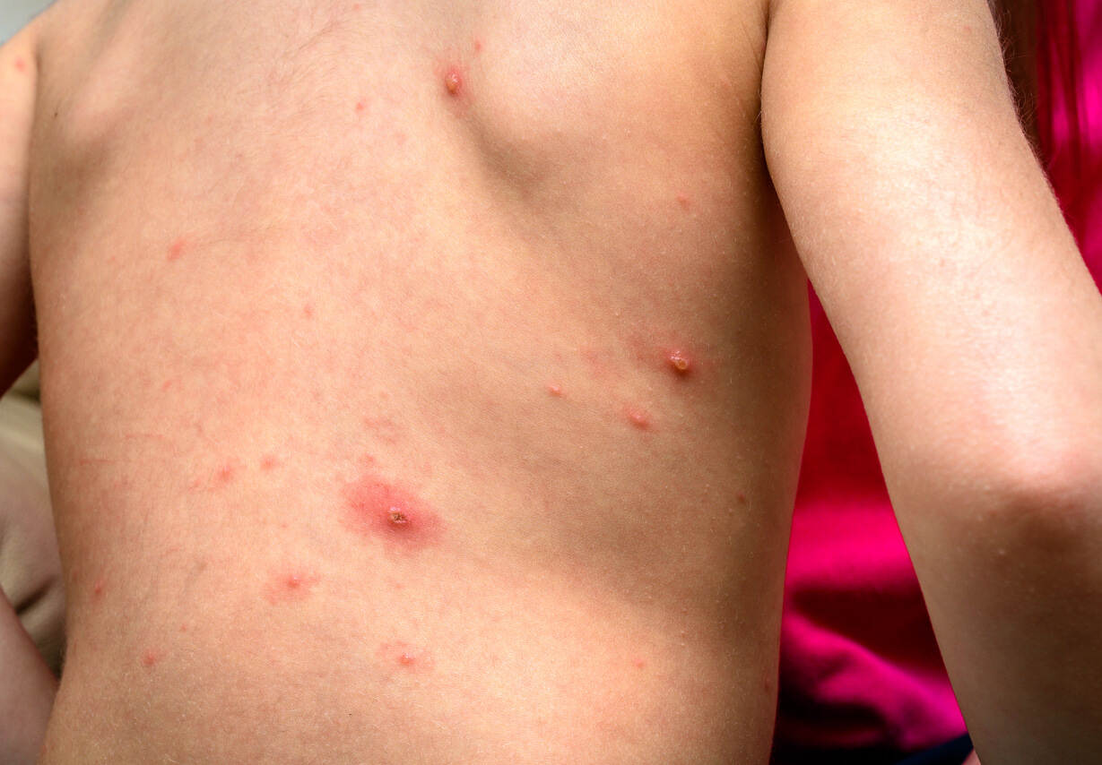 Monkeypox in children.