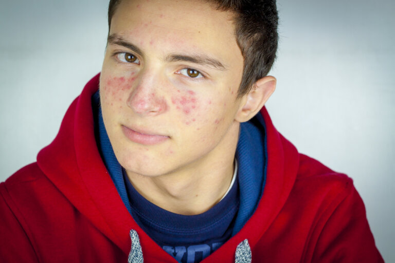 Adolescentes y acné: qué hacer y qué no