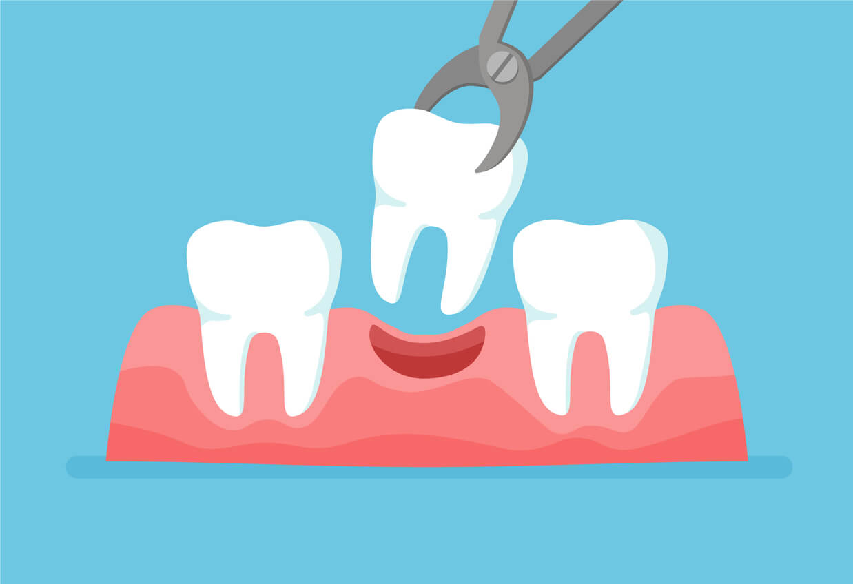 A cartoon image of a dental extraction.