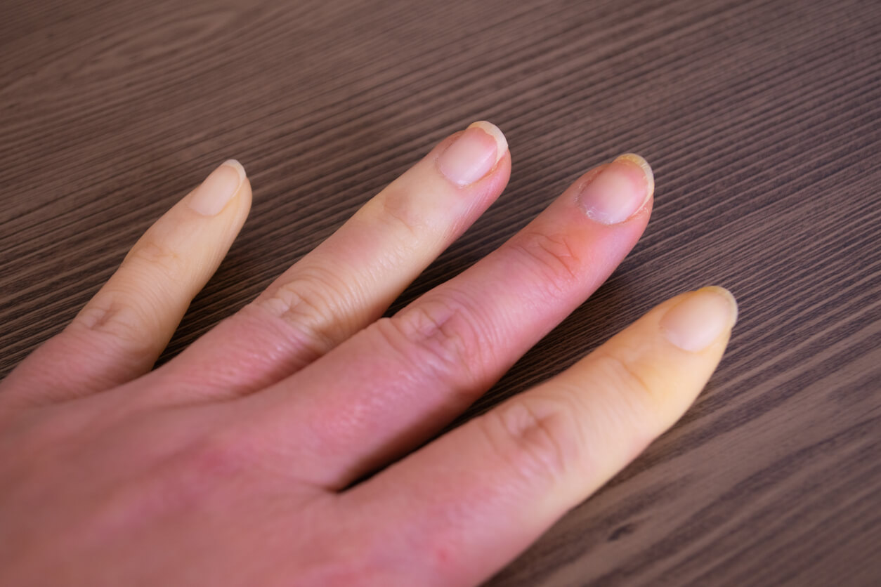 A woman with pale fingertips due to Raynaud's syndrome.