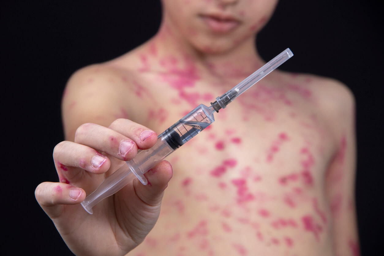 Et barn med hudutslett holder opp en vaksine.