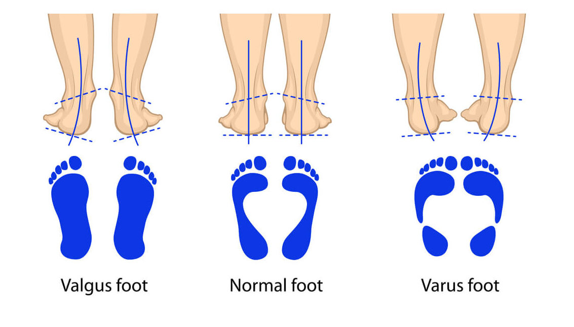 Normal, valgus, and varus footprints.
