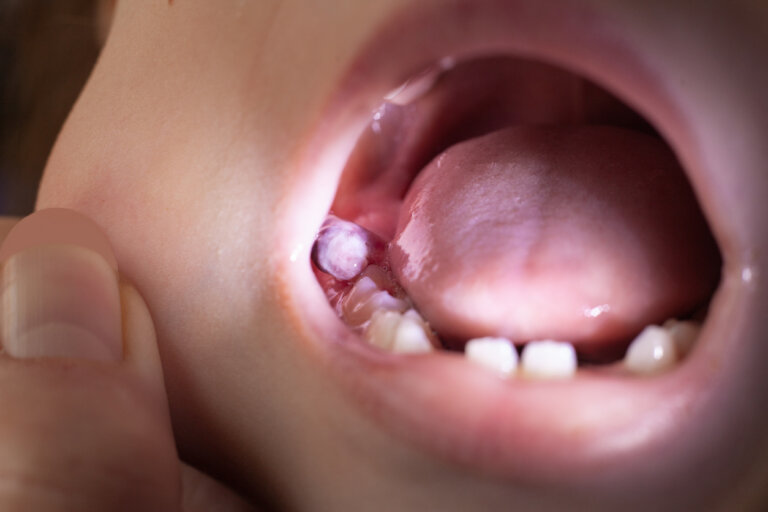 Quiste dental en niños: cómo tratarlo