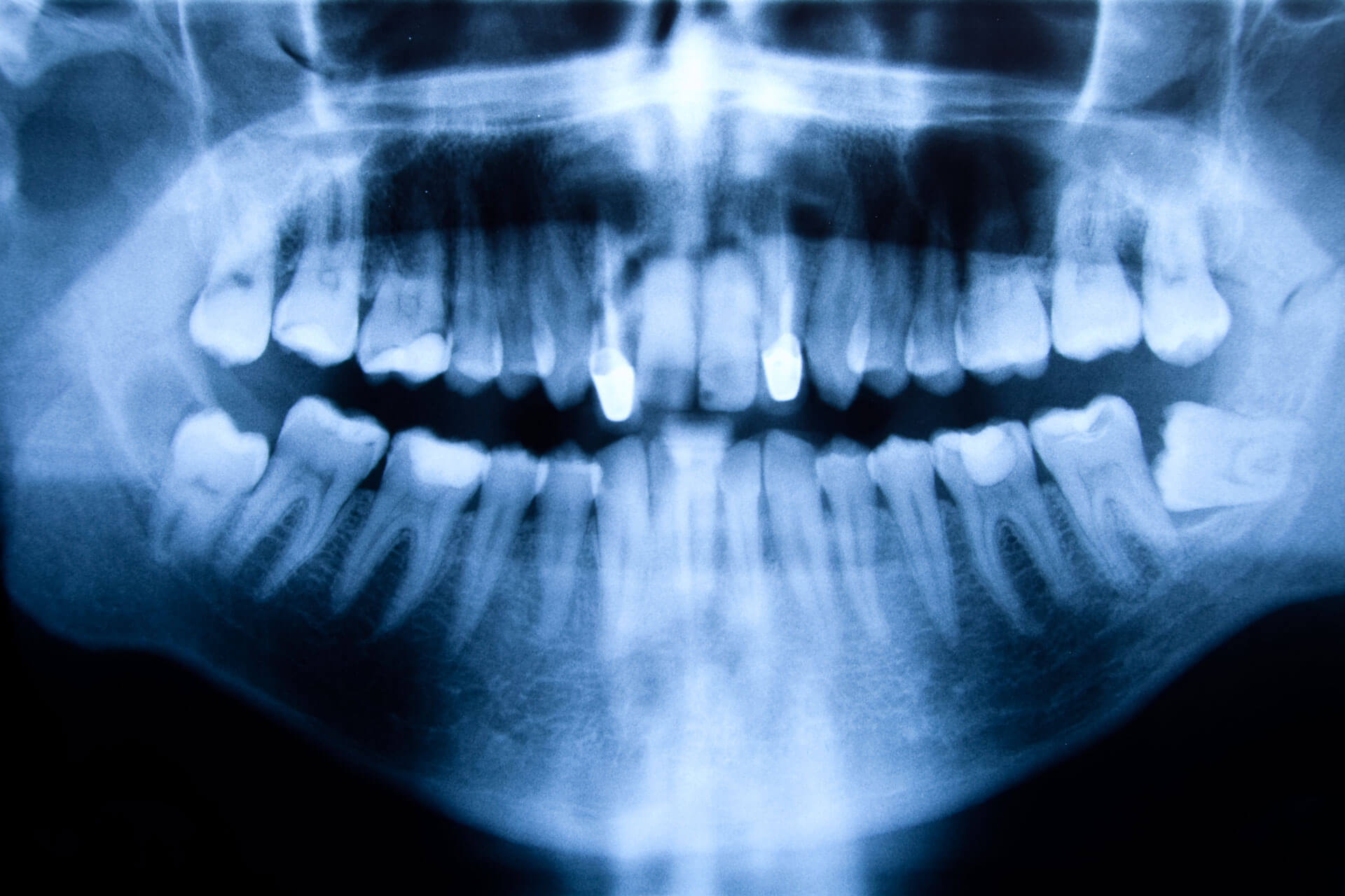 An x-ray of a child's mouth.