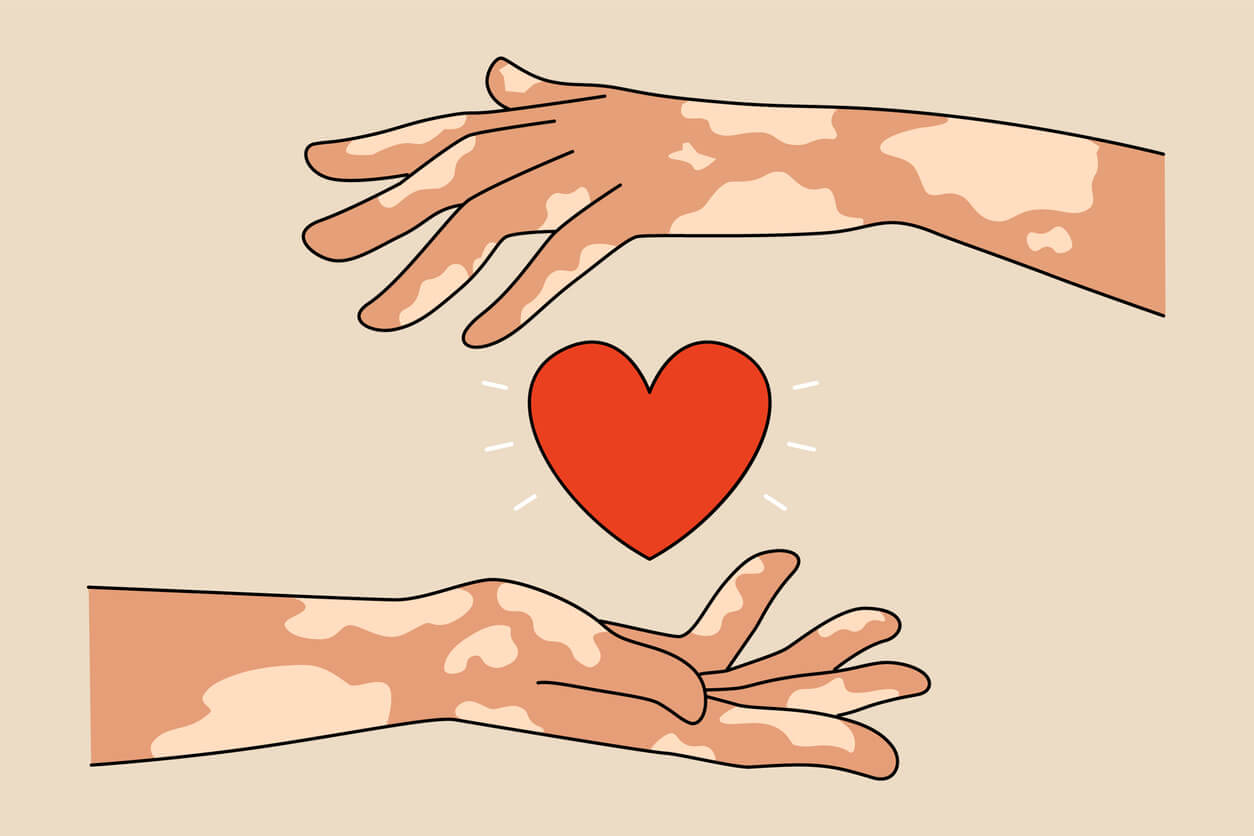 A computer drawing of hands with vitiligo holding a heart.