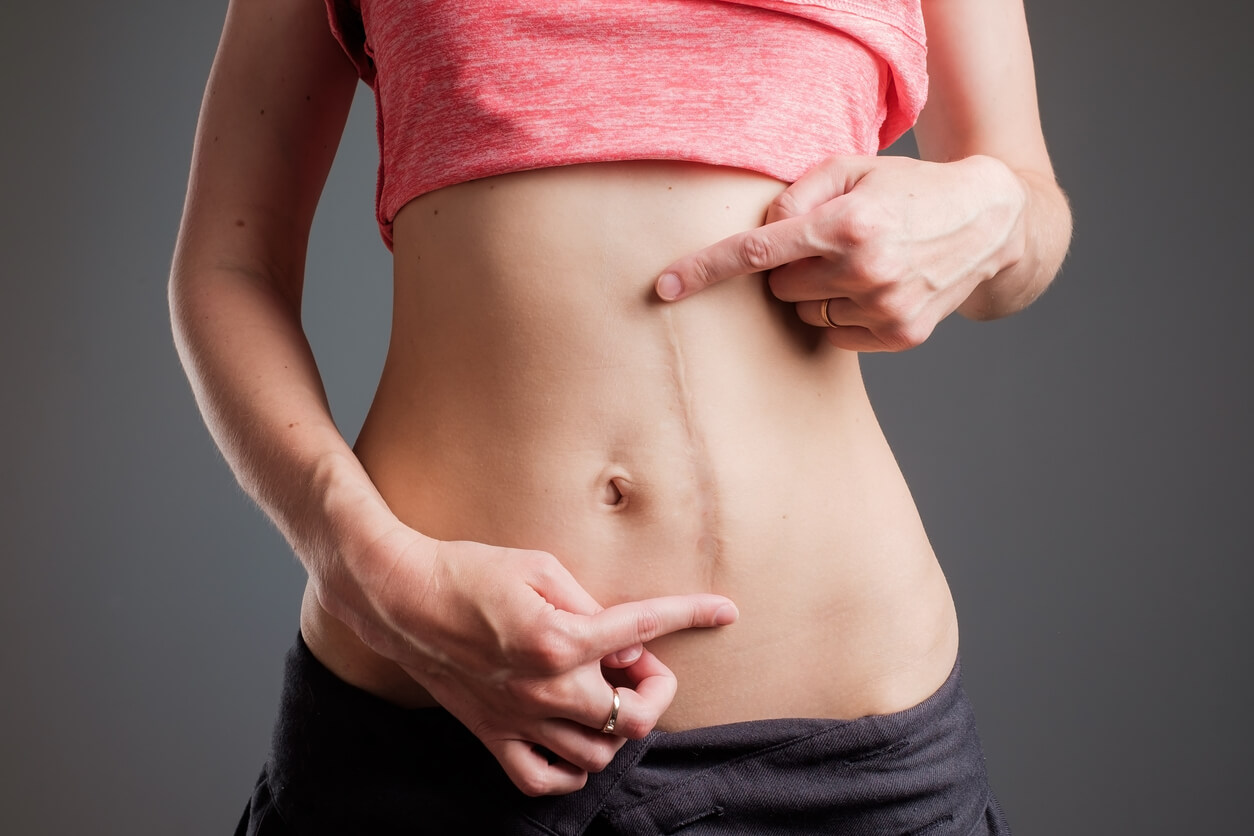 mujer delgada muestra cicatriz abdominal paramedial