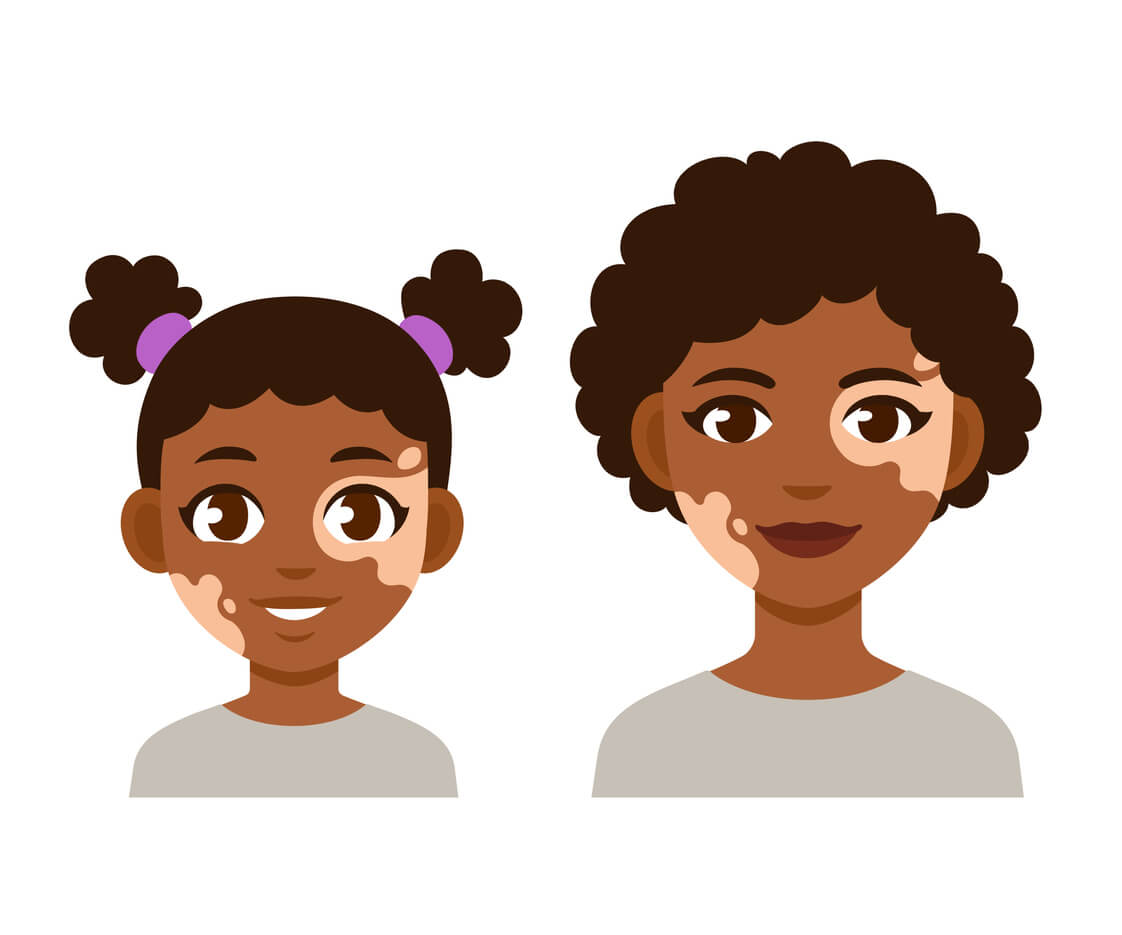 En datorteckning av en mor och dotter med vitiligo.