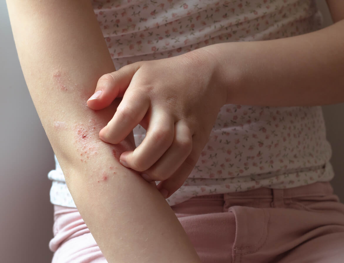 Boda Seguir domesticar Vitiligo en niños: síntomas, causas y tratamiento - Eres Mamá