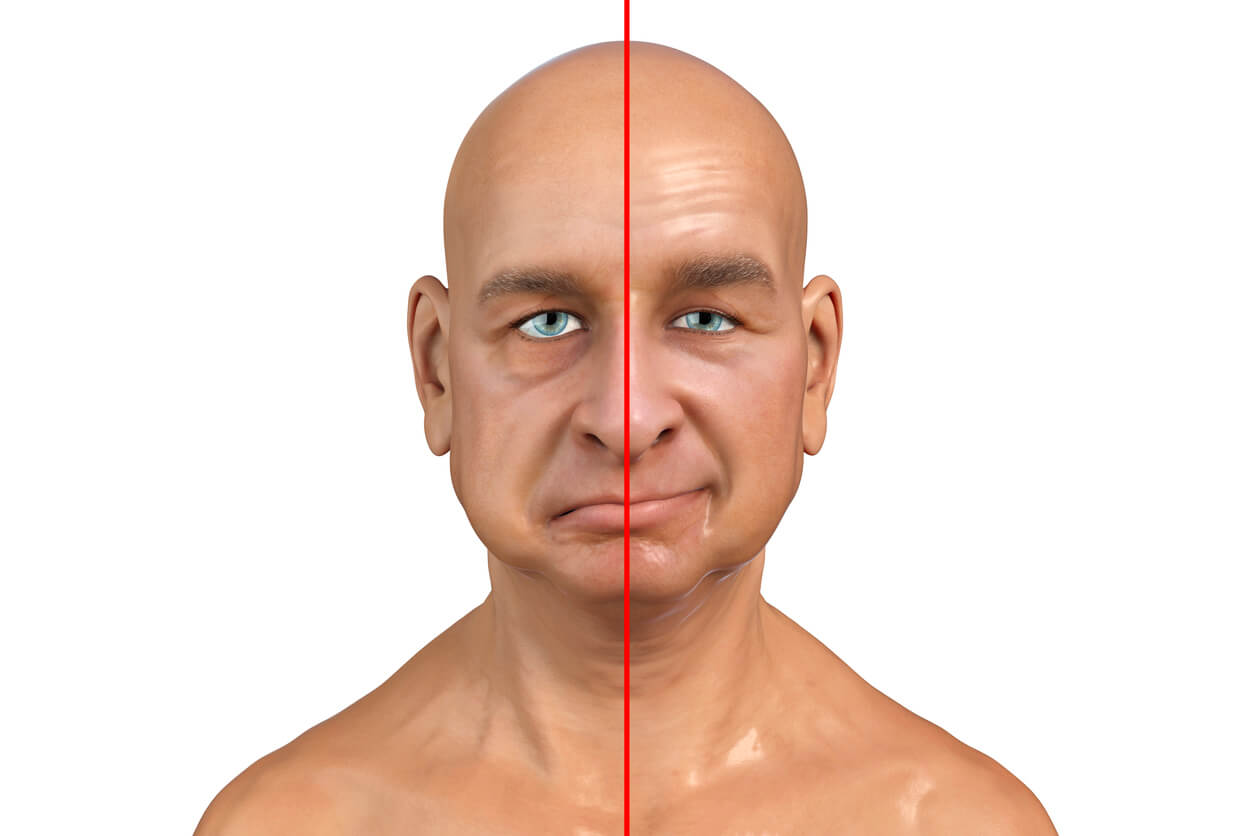 A digital image of a man with facial paralisis on one side.