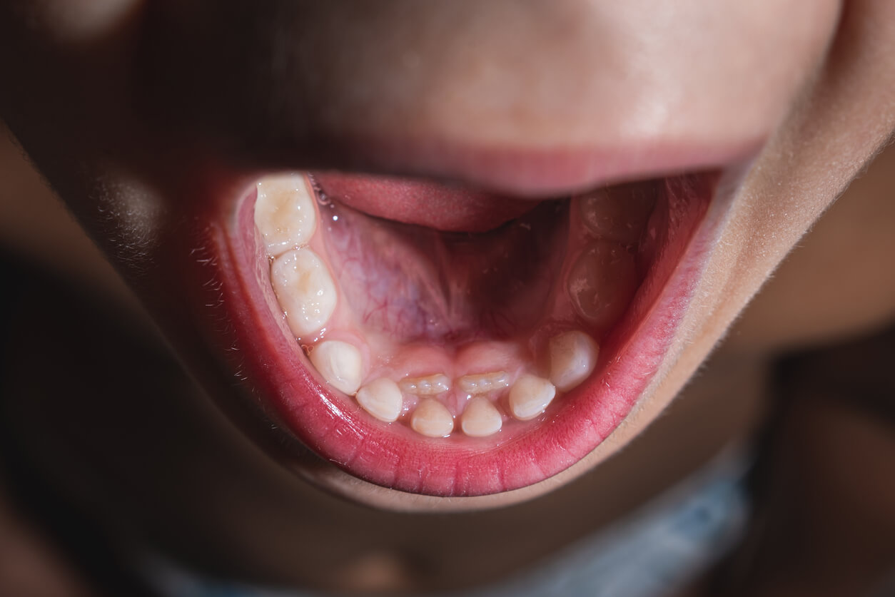 Dents qui se chevauchent dans la bouche d'un enfant;