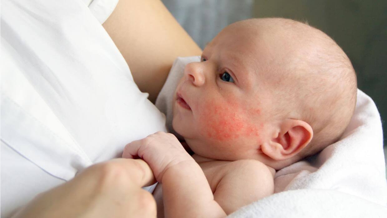 A woman holding a newborn with red spots on his cheeks.