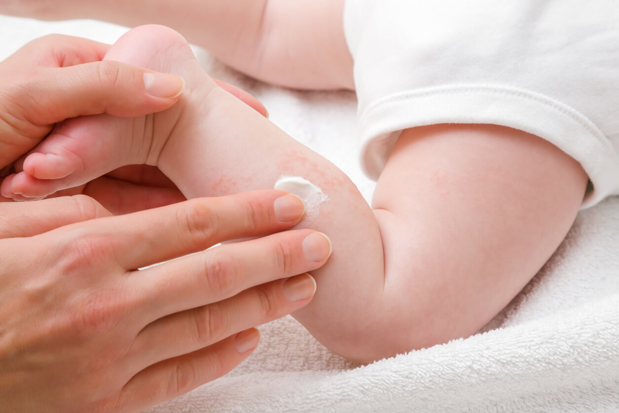 En bebis med reaktiv hud.