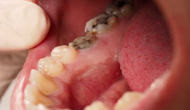 Dentinogénesis imperfecta: todo lo que necesitas saber