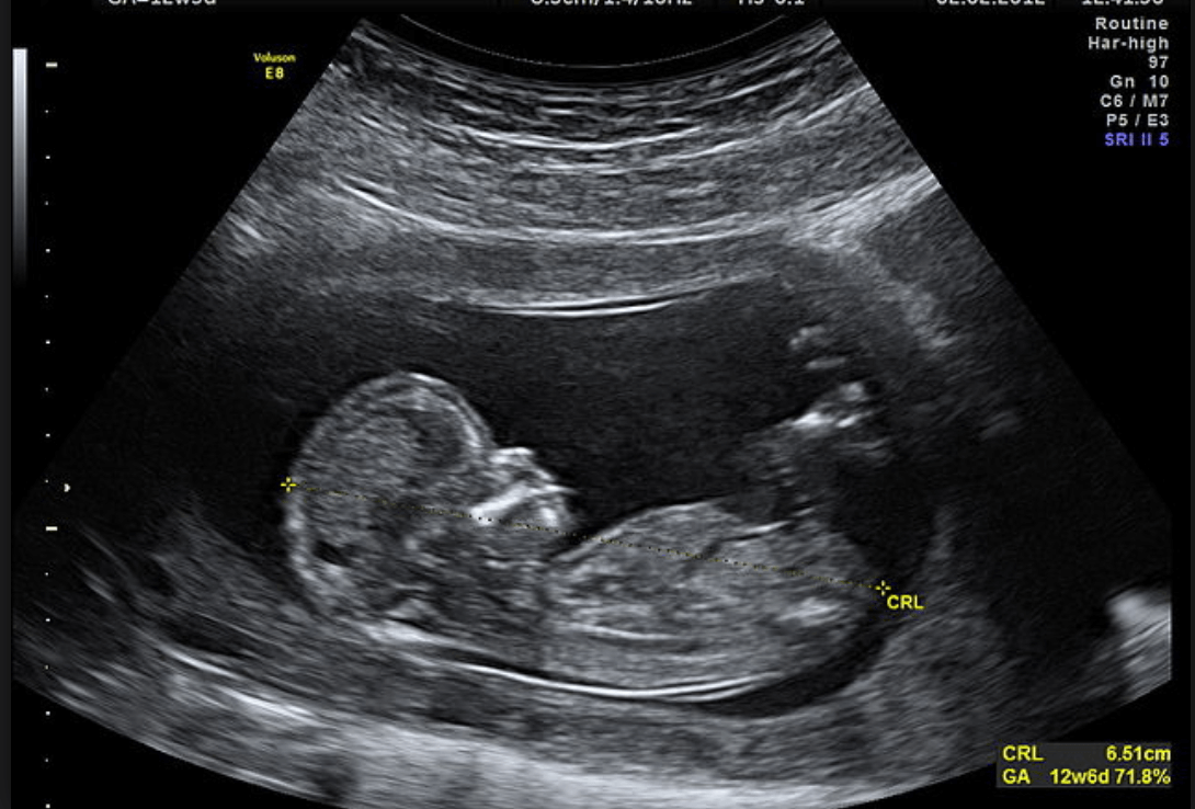 An image of a baby from an ultrasound.
