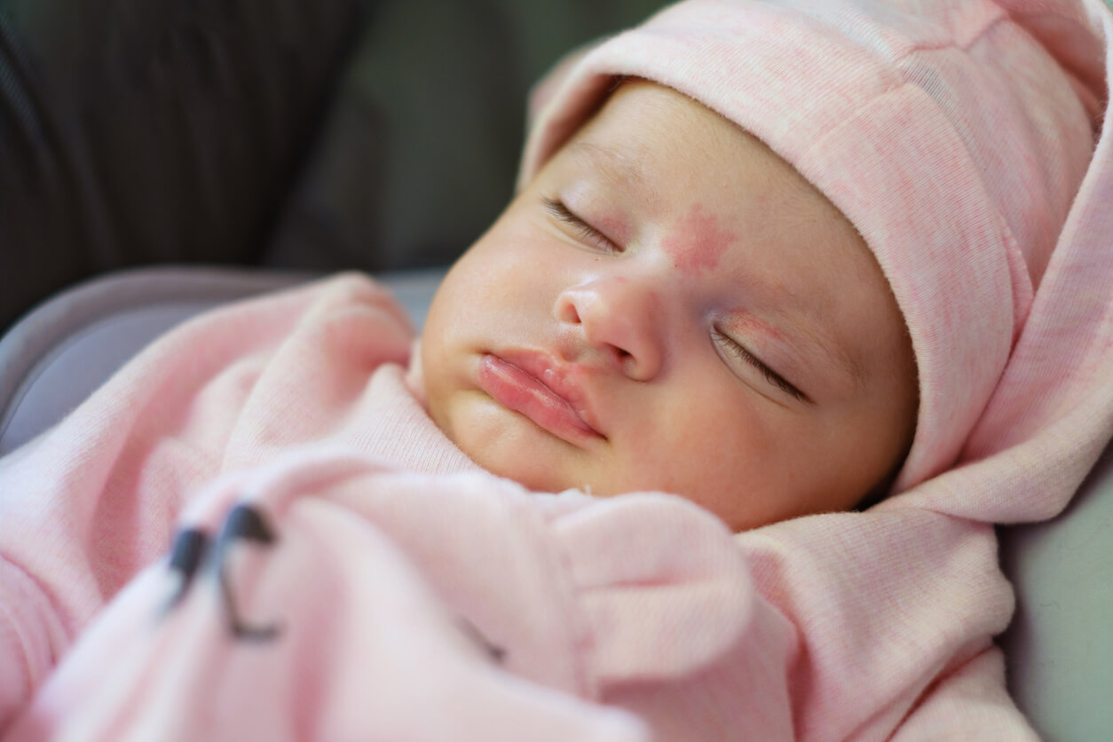 A baby with pink spots on her forehead and eyelids.