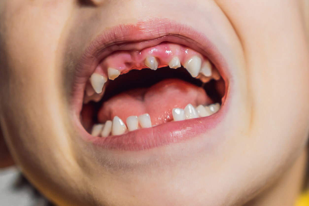 A child with very crooked teeth.