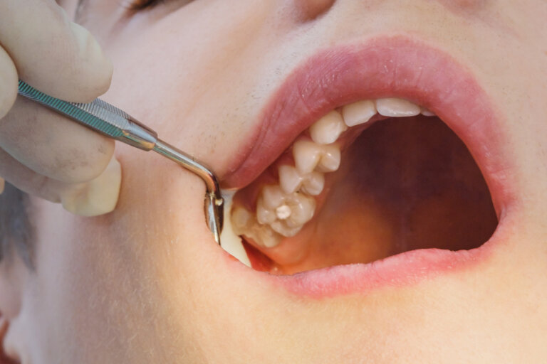 Cómo se tratan las caries en los dientes de leche y en los definitivos