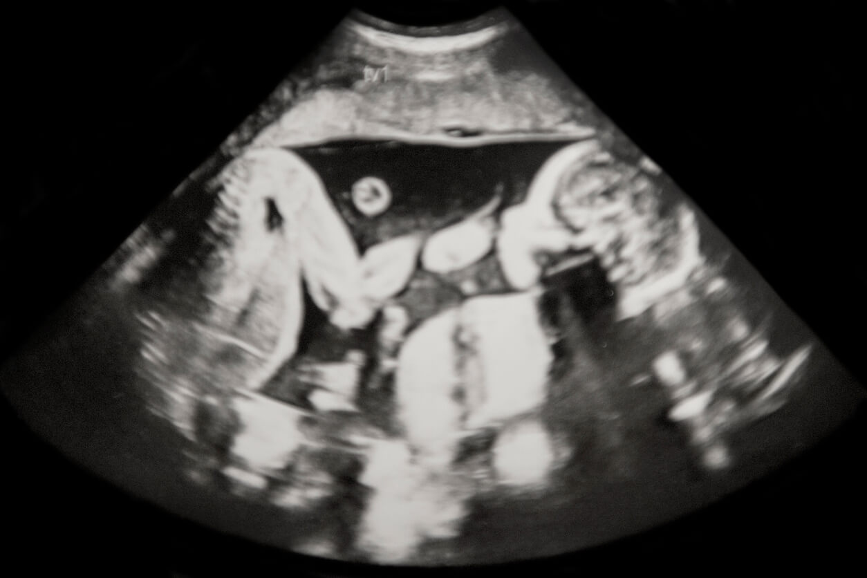 An ultrasound of a multiple pregnancy.