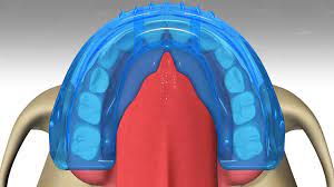 ¿Qué es el sistema Myobrace ® para alinear los dientes?