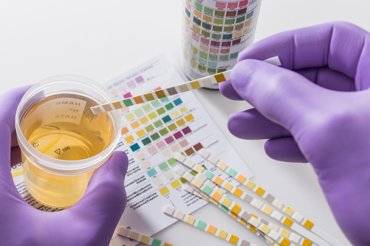 A lab technician testing urine with a dipstick.