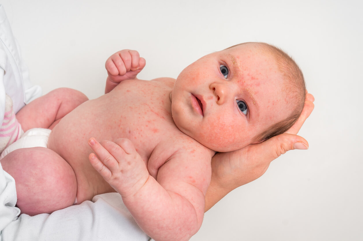 A baby with red spots on his face and chest.