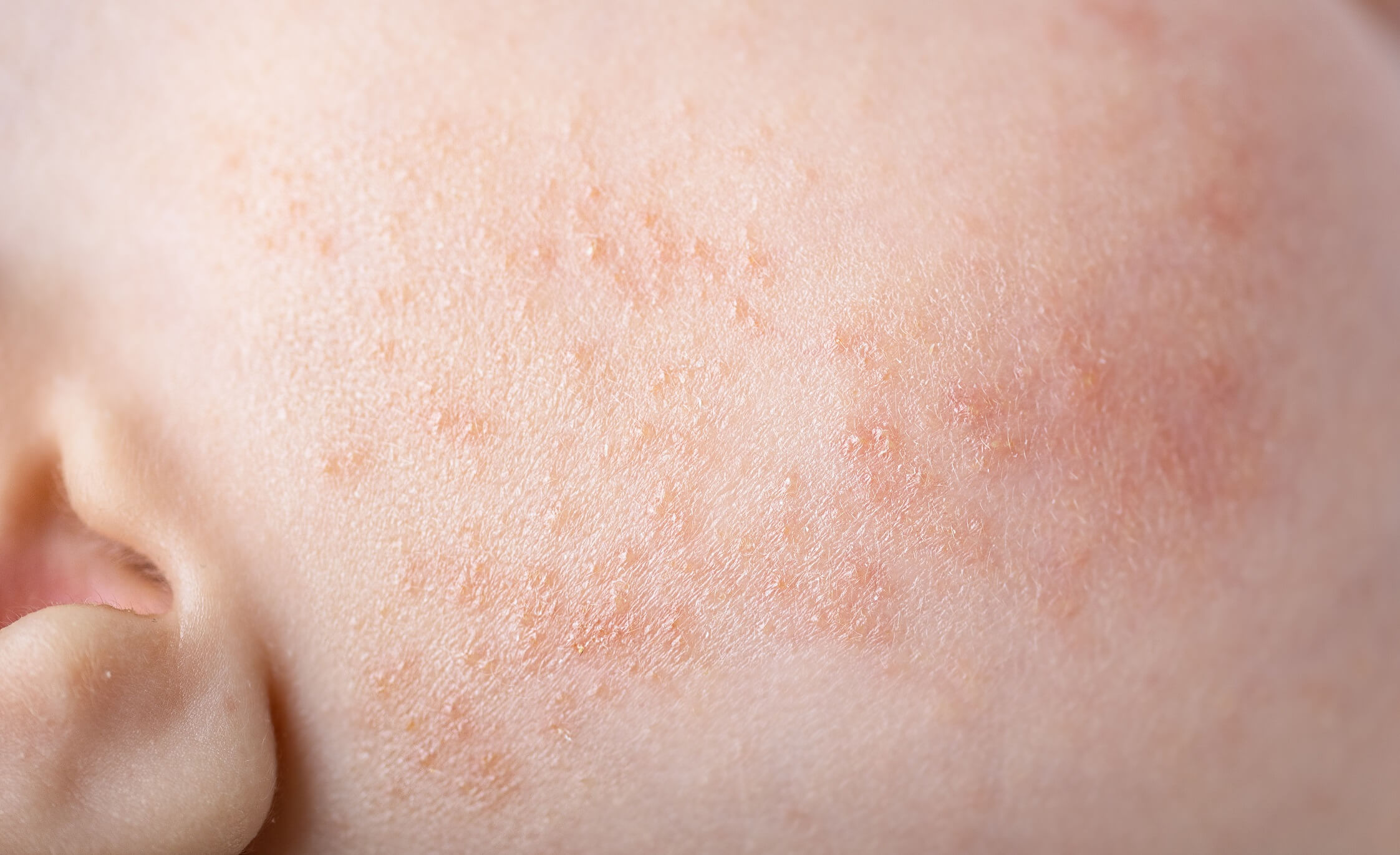 Miliary Rash Type Milia in Babies: What You Should Know