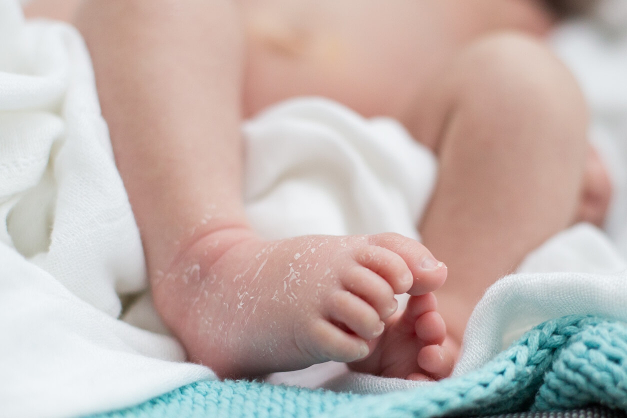Desquamation de la peau d'un bébé sur ses pieds.