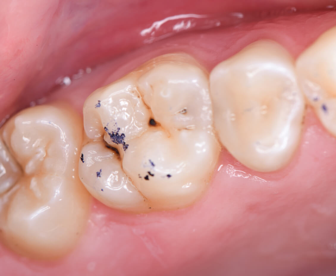 Stains on Children's Teeth Due to Iron Supplementation