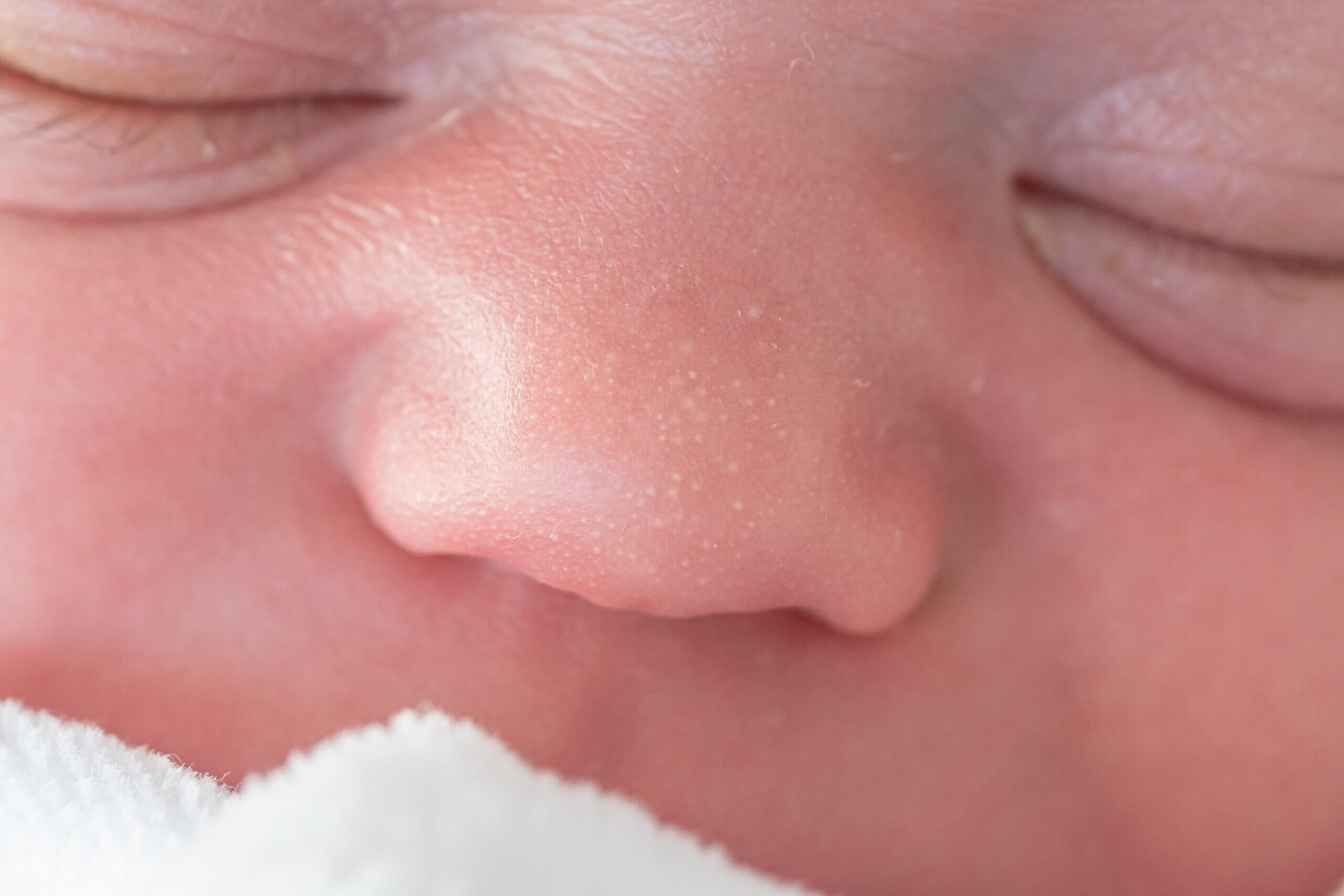 En baby med milia på nesen.