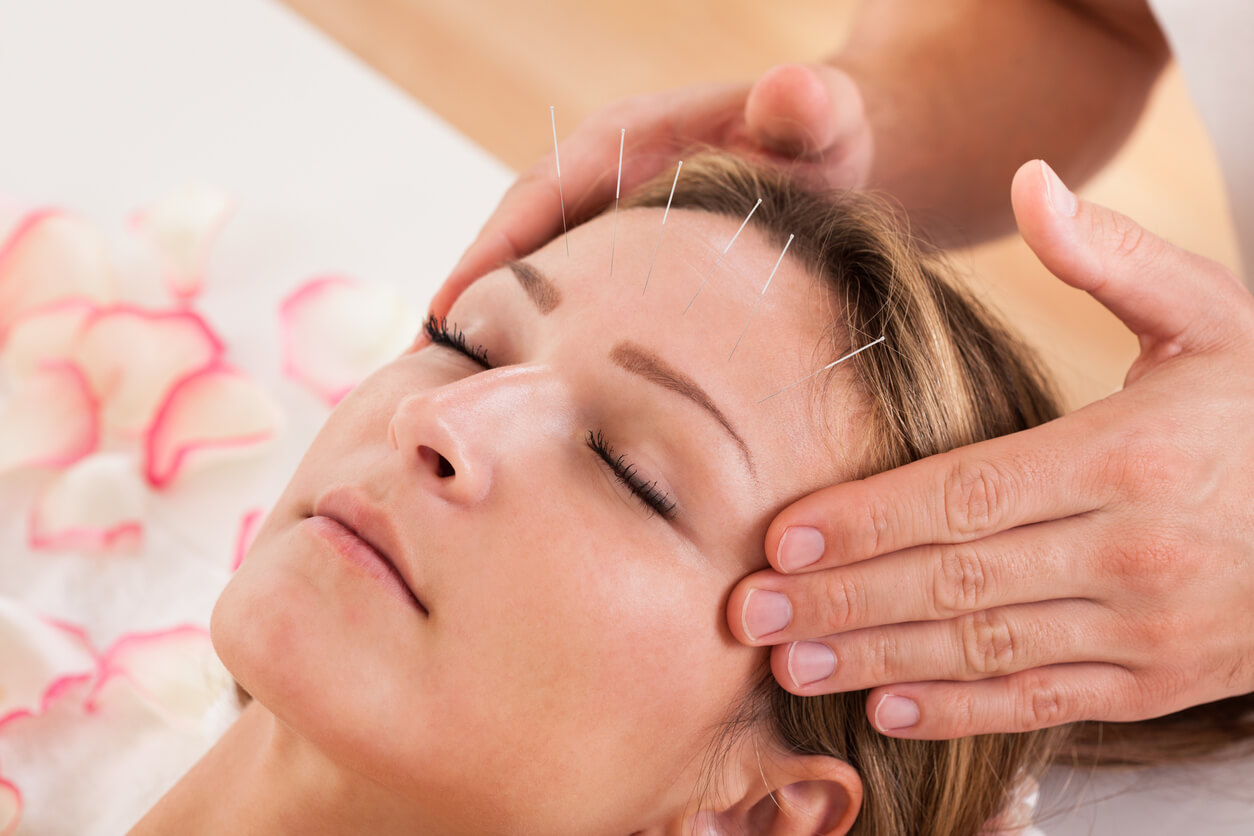 A woman with accupunture needles on her forehead recieving a massage to the temples.