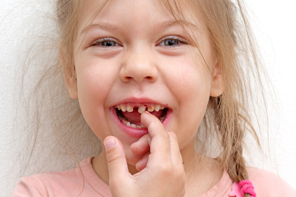 A little girl whose front tooth is about to fall out.