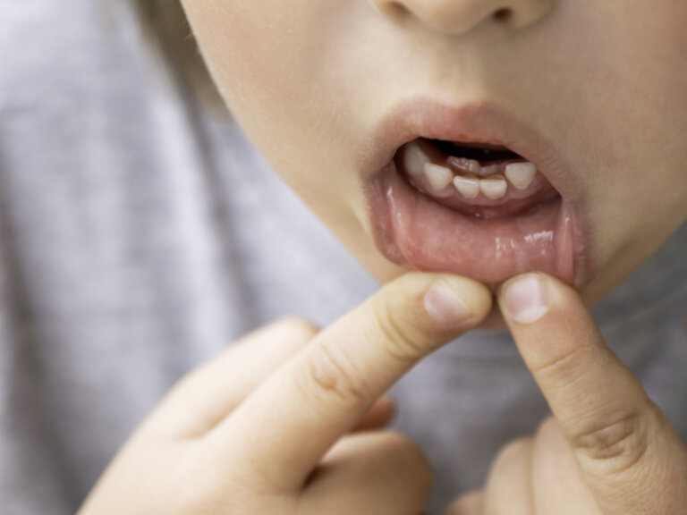 Dientes supernumerarios (o dientes de más): a qué se debe en los niños y cómo se trata